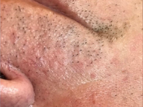 After Facial Rejuvenation