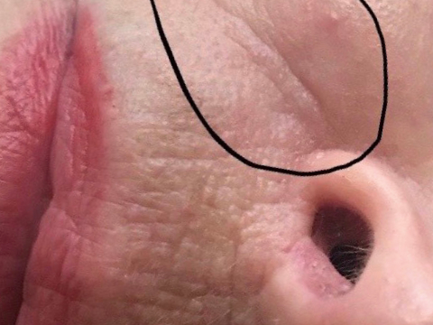 After Facial Rejuvenation