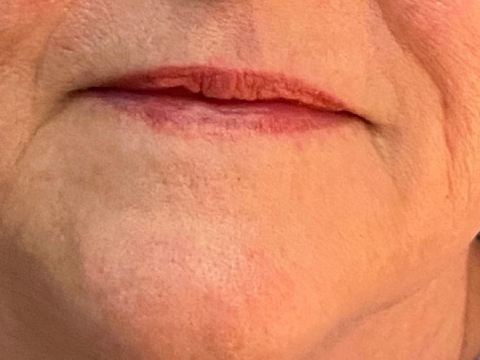 After Facial Rejuvenation