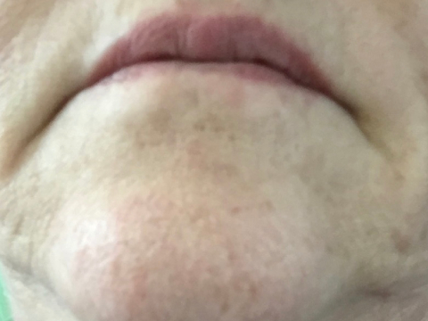 Before Facial Rejuvenation