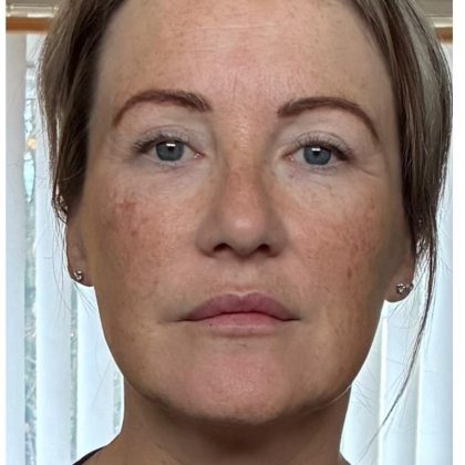 After 6 treatments